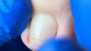 Curled toenails digging out black ingrown nails【Xue Yidao】