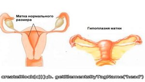Детская матка у женщины: можно ли забеременеть и родить с такой патологией?