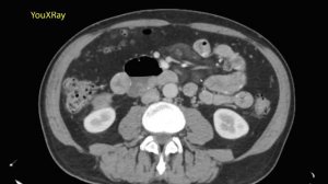 Лучевая диагностика брыжеечного панникулита на КТ