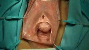 Komyakov technique of the transposition of female urethra