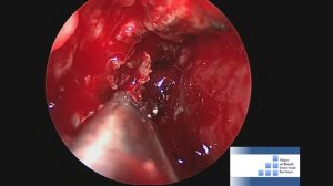 Endoscopic endonasal ligation of the sphenopalatine artery (SPA)