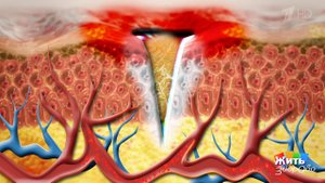 Раны. Секреты заживления. Жить здорово! Фрагмент выпуска от 28.06.2018