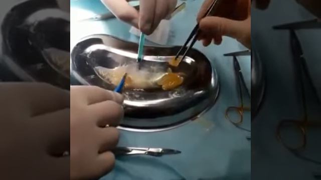 открытая ринопластика