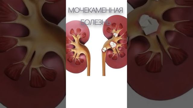 МОЧЕКАМЕННАЯ БОЛЕЗНЬ / Симптомы - Причины - Профилактика