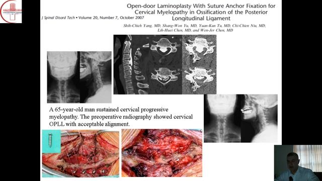 Хирургическое лечение заболеваний и повреждений шейного отдела позвоночника смотреть онлайн