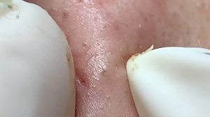 Treatment Of Blackheads And Hidden Acne #057