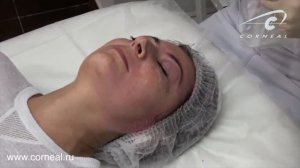 Пилинги и карбокситерапия