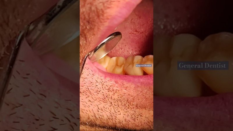 Longitudinal fracture of a tooth 47. #dentist #fracturetootn