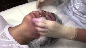 Пилинги и карбокситерапия