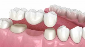 Зубной мост на основе 2 зубов
