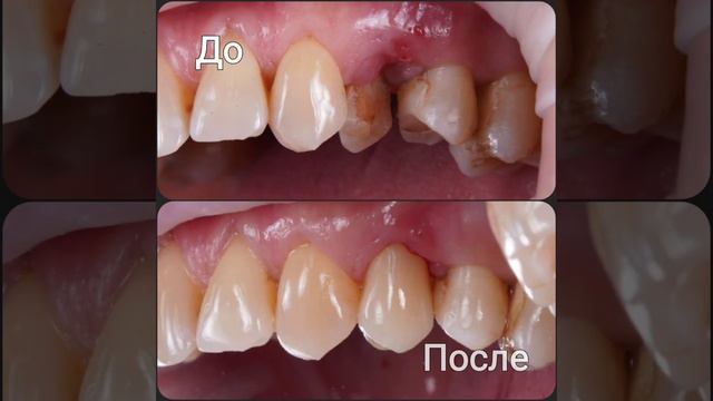 Перелом корня зуба смотреть онлайн