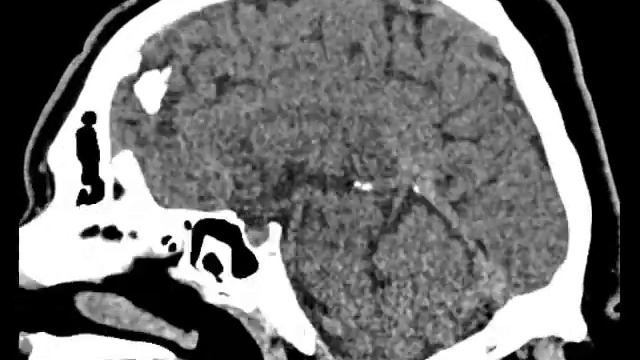 образование орбиты саггитальная проекция смотреть онлайн