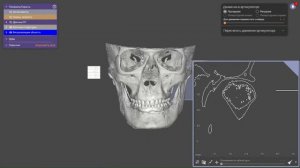 Exocad-Цифровой вариатор / Digital Variator for Exocad