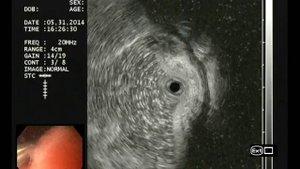 Stomach adeocarcinoma G-2. Endosonography, uT1bN0. Эндосонография при аденокарциноме желудка