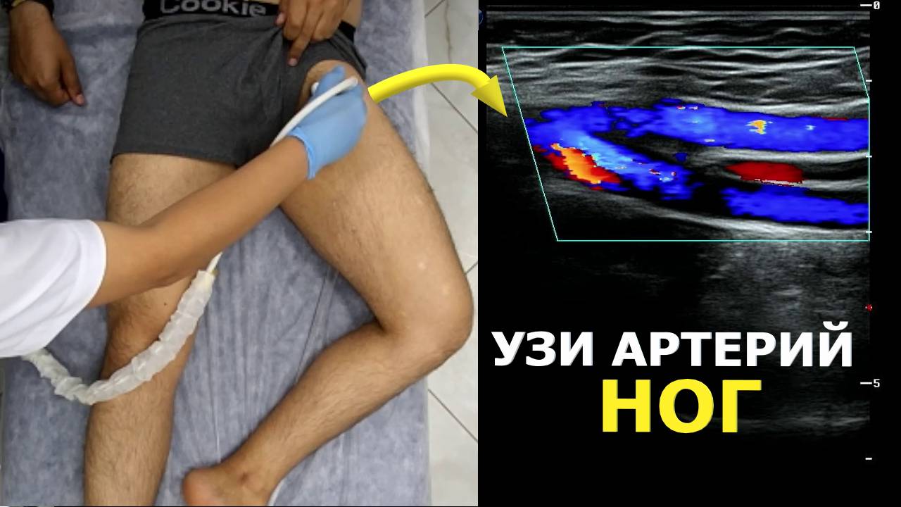УЗИ Артерий Нижней Конечности с демонстрацией датчика. Пишем ПРОТОКОЛ вместе.