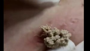 Выдавливаем гной