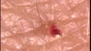 Укус постельного клопа Как кусаю постельные клопы