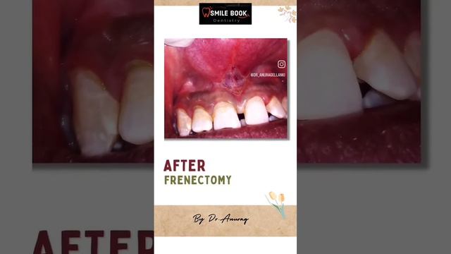 Painless LASER treatment for frenum #cosmetics #hyderabad #smile #dentist #invisalign #implant