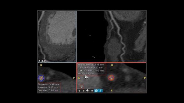 CTA 1.1