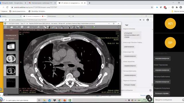 КТ легких от синдрома к диагнозу День первый платформа Webinar ru Google Chrome 2020 11 27 1 смотреть онлайн