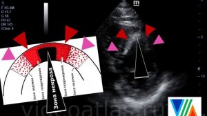 Инфаркт переднеперегородочный (наглядный пример + схема повреждения)