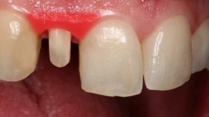 Для Чего Нужны Временные Коронки?