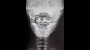 Верхнешейная кайропрактика. Часть 2.  Диагностика подвывиха атланта