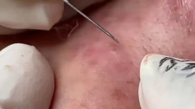 Каждый день залипательное видео Выдавливание черных точек прыщей