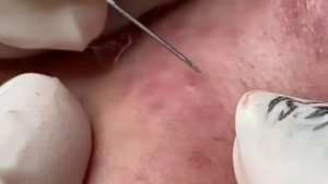 Каждый день залипательное видео Выдавливание черных точек прыщей