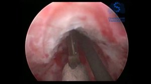 Стриктура уретры. Клинический пример рассечения стриктуры уретры холодным ножом.