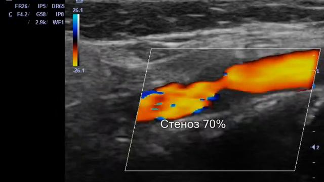 Cтенозирующий атеросклероз НСА, гемодинамически значимый. смотреть онлайн