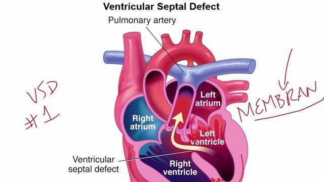 USMLE RX - 2.Кардиология - 3.Патология - 12.Врождённые Пороки Сердца