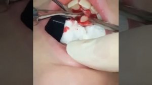 Сверхкомплектные зубы