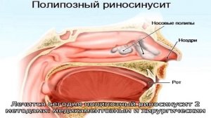 Как проявляется и чем лечится полипозный риносинусит