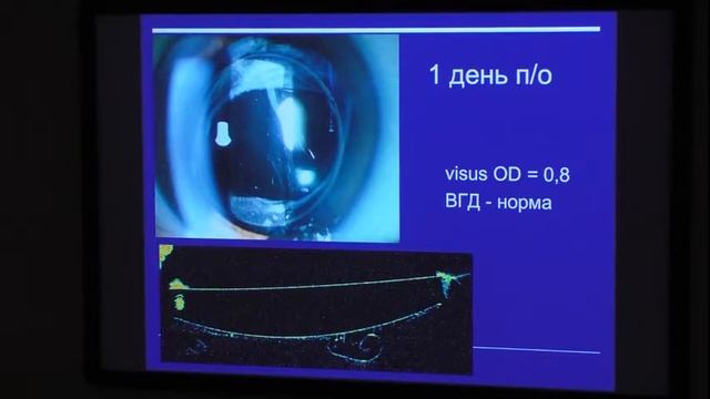 Замена помутневшей ИОЛ