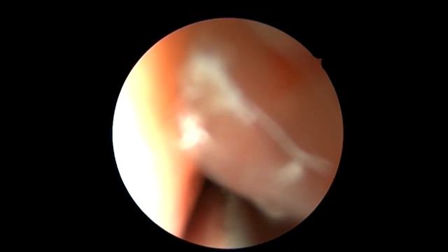 Полипы в носу. смотреть онлайн