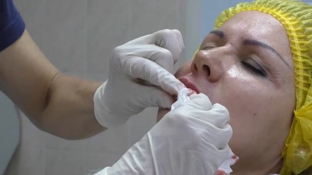 Врач-косметолог Зайцева Ирина. Процедура введения филера для улучшения контура и омоложения губ.