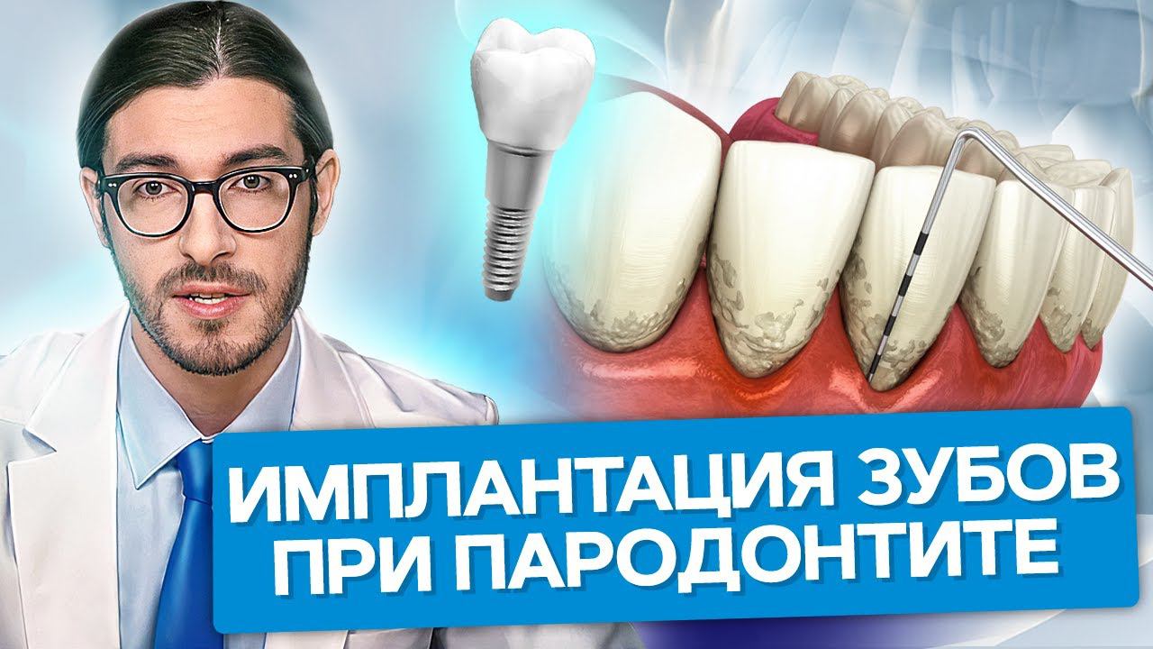 Имплантация зубов при пародонтите. Можно ли проводить имплантацию зубов при пародонтите?