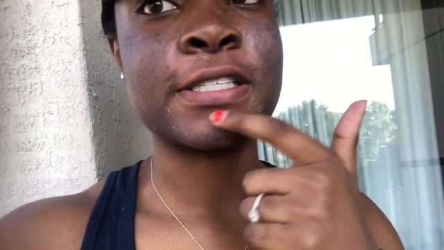 I GOT A CHEMICAL PEEL FOR HYPERPIGMENTATION | BEFORE & AFTER RESULTS смотреть онлайн