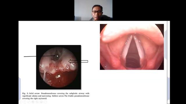 Difteri смотреть онлайн