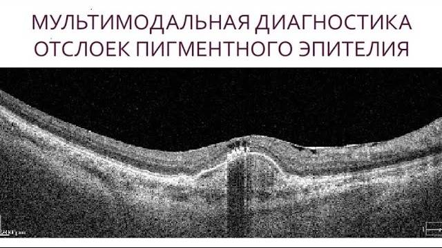 Мультимодальная диагностика отслоек пигментного эпителия
