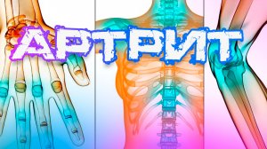 Артрит: раскрываем секреты лечения и профилактики с врачом-неврологом Белозёровой!