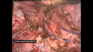 Полностью лапароскопическое удаление 7 го сегмента печени, замещенного эхинококковой кистой