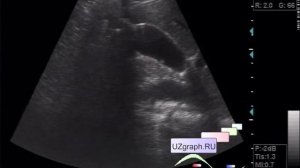 УЗИ брюшной полости - Полип желчного пузыря