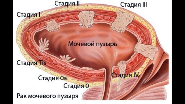 КАК РАЗЛИЧАЮТСЯ СТАДИИ РАКА. ЧТО ТАКОЕ РАК, И КАК ОН ЛЕЧИТСЯ смотреть онлайн