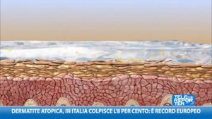 Dermatite atopica, in italia colpito l'8 per cento: è record europeo