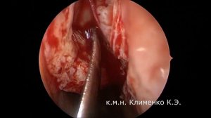 Расширенная фронтотомия DRAF III. Хронический фронтит и мукоцеле лобных пазух