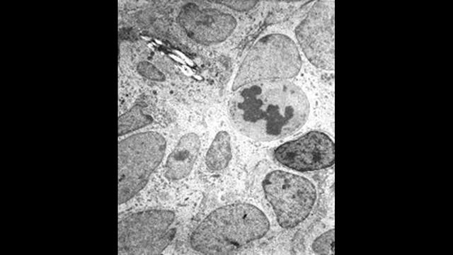 Как лечить и вылечить десмопластической опухоль малого круглого клеток смотреть онлайн