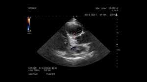 Сначала предполагал вариант коронарно-лёгочной фистулы