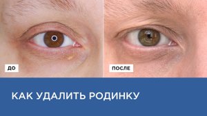 УДАЛЕНИЕ РОДИНОК